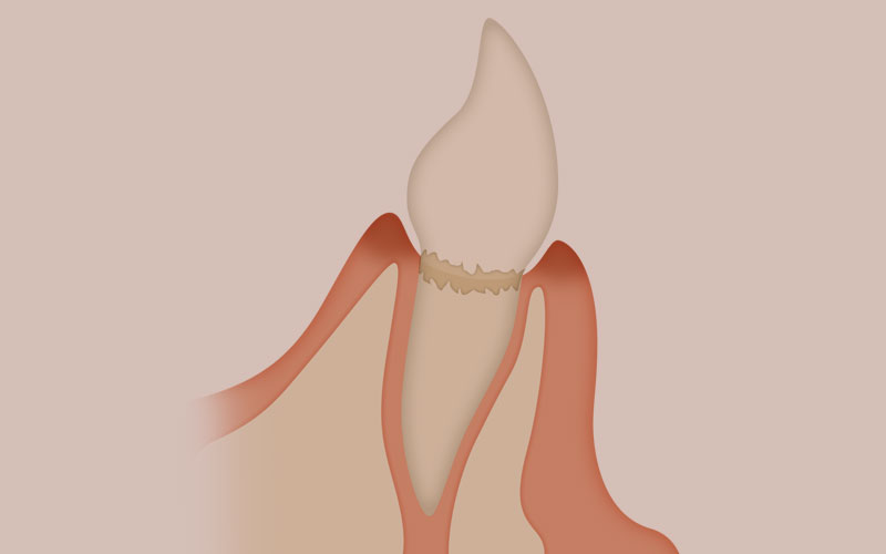初期の虫歯