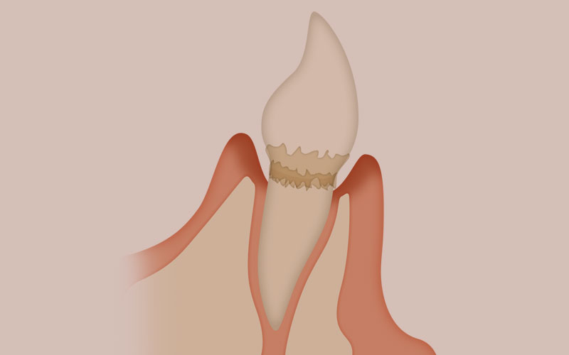 中期の虫歯