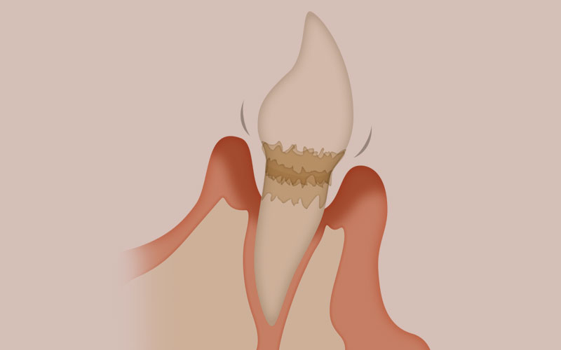 後期の虫歯
